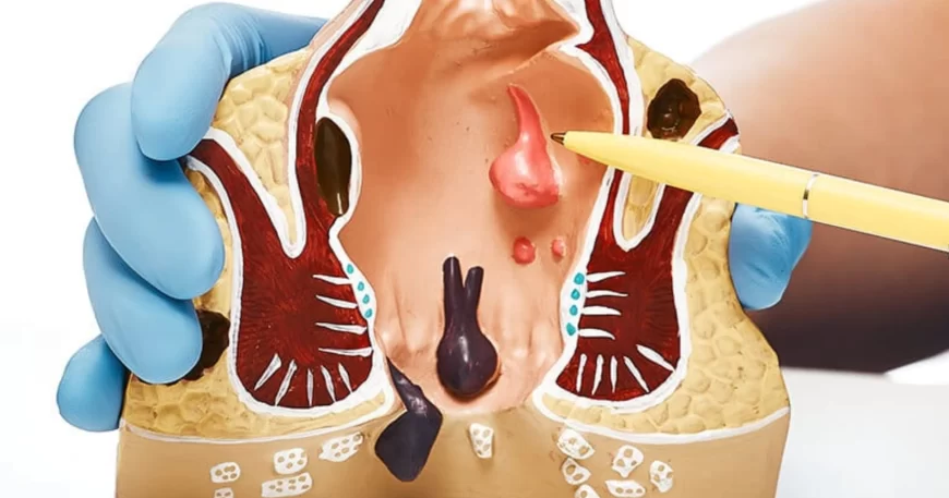 Fistulas anales y abcesos colorectales - Dr David Mayo Coloproctólogo en Bogotá