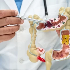 Pólipos de colon y recto: detección temprana, riesgos y tratamiento