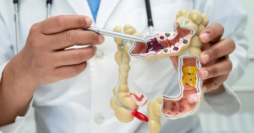 Polipos de colon y recto - Dr David Mayo Coloproctólogo en Bogotá