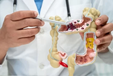 Polipos de colon y recto - Dr David Mayo Coloproctólogo en Bogotá