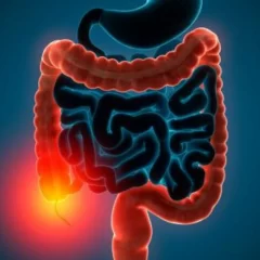 Colitis ulcerativa y enfermedad de Crohn: diagnóstico y manejo de las complicaciones anorrectales
