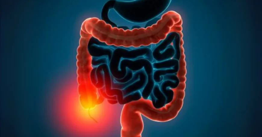 Colitis Ulcerativa - Dr David Mayo Coloproctólogo en Bogotá