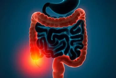 Colitis Ulcerativa - Dr David Mayo Coloproctólogo en Bogotá