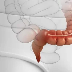 Angiodisplasia e isquemia colónica: causas de sangrado digestivo bajo