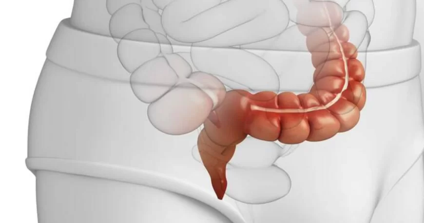 Sangrado Digestivo Bajo - Dr David Mayo Coloproctólogo en Bogotá