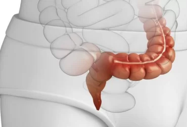 Sangrado Digestivo Bajo - Dr David Mayo Coloproctólogo en Bogotá