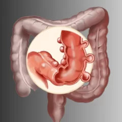 Enfermedad diverticular del colon: síntomas, diagnóstico y tratamiento