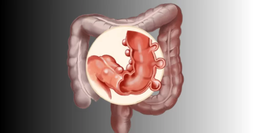 Enfermedad Diverticular - Dr David Mayo Coloproctólogo en Bogotá
