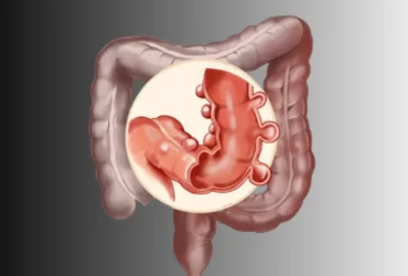Enfermedad Diverticular - Dr David Mayo Coloproctólogo en Bogotá